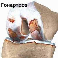 Гонартроз (артроз коленного сустава)